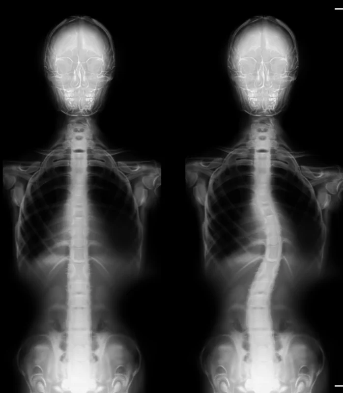 Scoliosis Treatment In Newtown Square